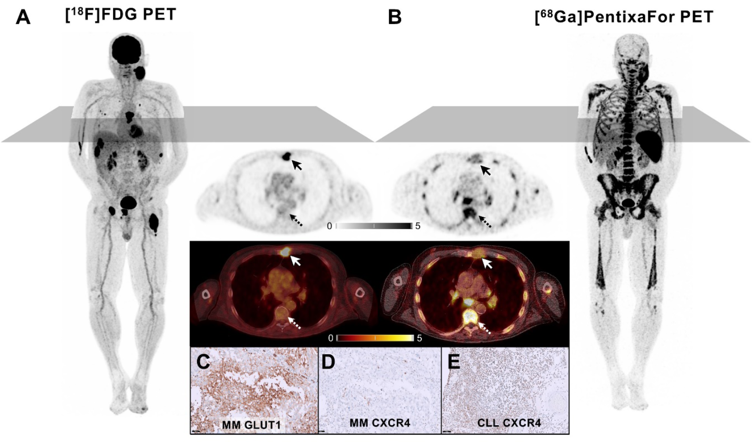 Disclosing tumor biology by means of molecular imaging in a patient with malignant melanoma and chronic lymphocytic leukemia