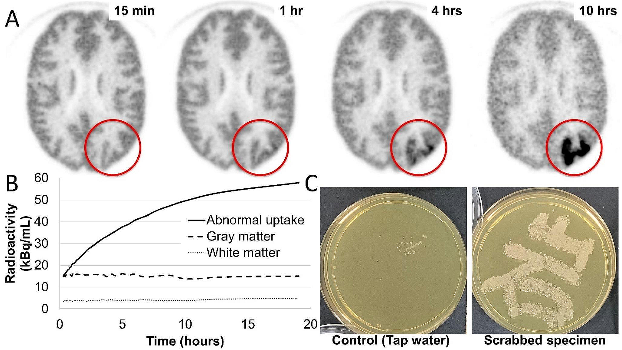 Abnormal localized [18F]FDG accumulation in a Hoffman 3D brain phantom caused by Pseudomonas aeruginosa and Stenotrophomonas maltophilia