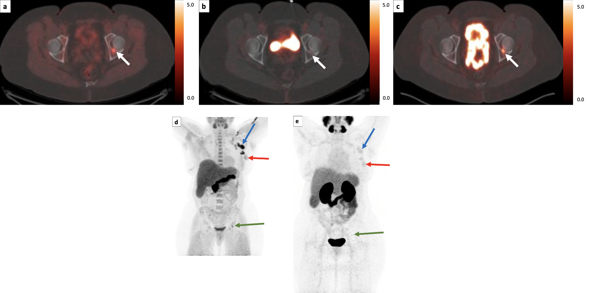Prospective investigation of amino acid transport and PSMA-targeted positron emission tomography for metastatic lobular breast carcinoma