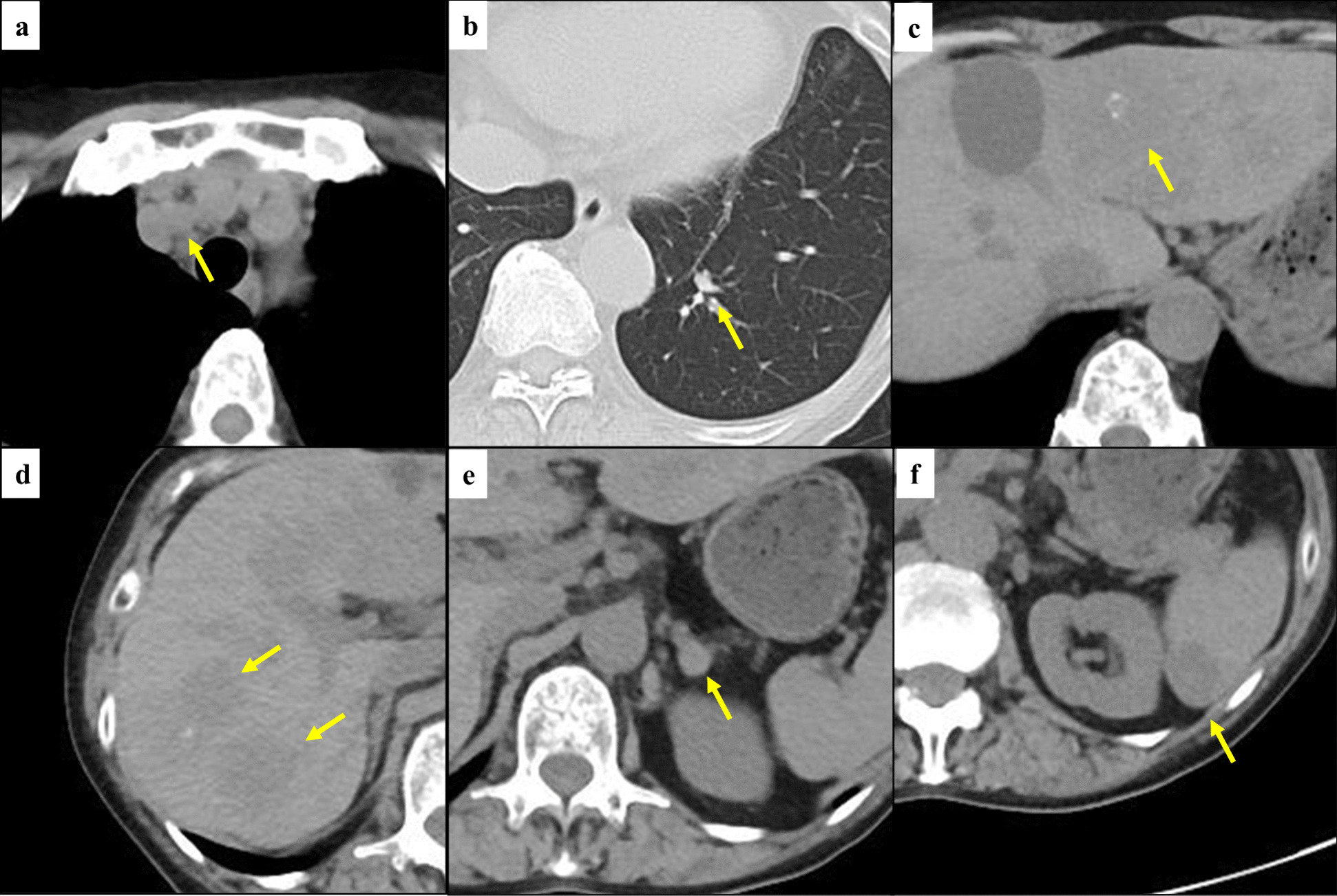 Larotrectinib efficacy for liver metastases in papillary thyroid carcinoma patient harboring SQSTM1–NTRK1 fusion