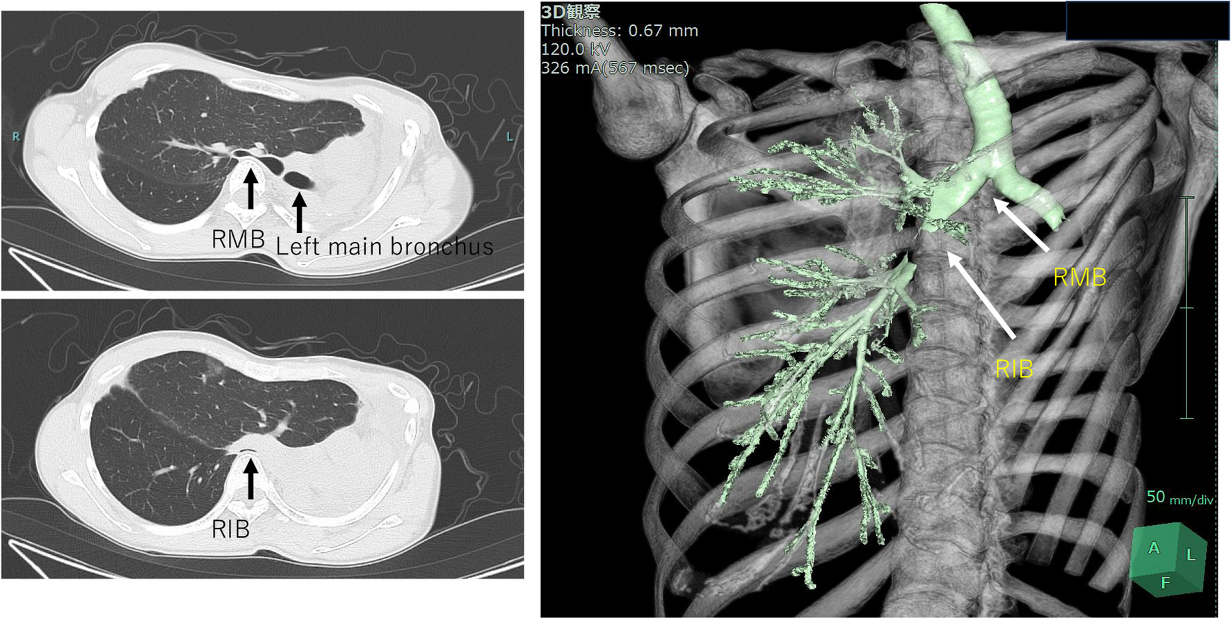 SF6 is a useful expander for post-pneumonectomy syndrome in the long-term course: a case report