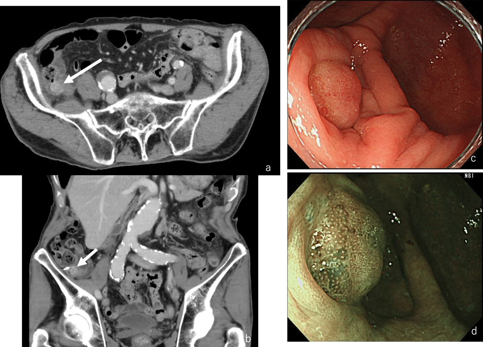 Appendiceal goblet cell adenocarcinoma newly classified by WHO 5th edition: a case report (a secondary publication)