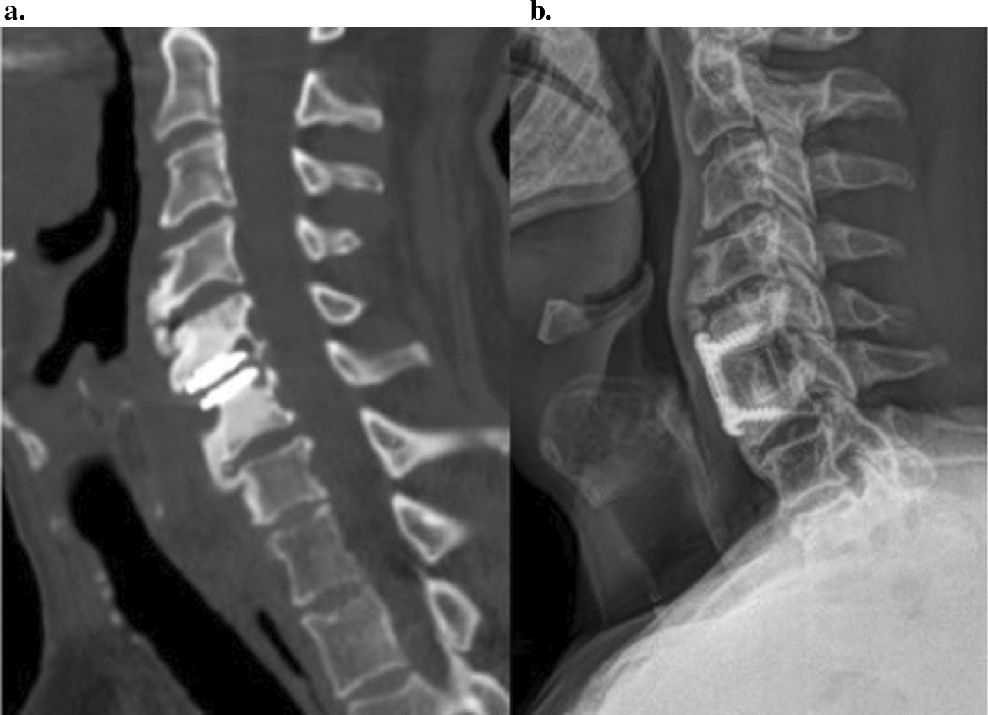 Treatment of failed cervical total disc replacements in a series of 53 cases and description of a management strategy
