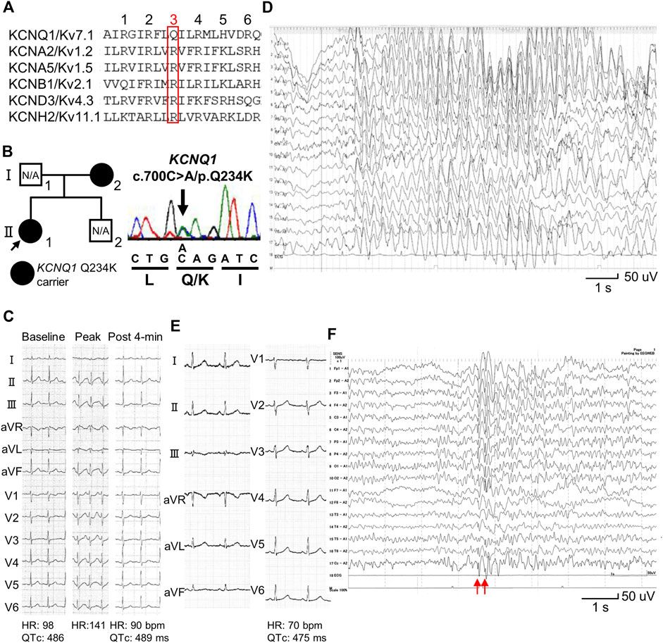 Novel KCNQ1 Q234K variant, identified in patients with long QT syndrome and epileptiform activity, induces both gain- and loss-of-function of slowly activating delayed rectifier potassium currents