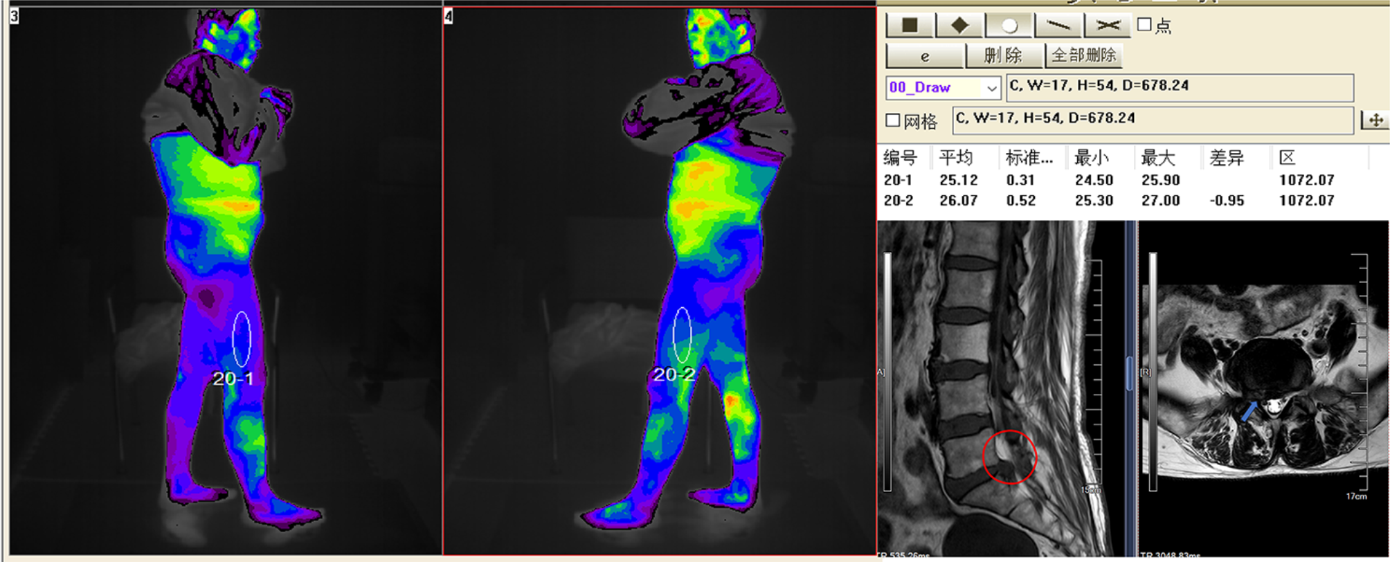 The diagnostic accuracy of infrared thermography in lumbosacral radicular pain: a prospective study