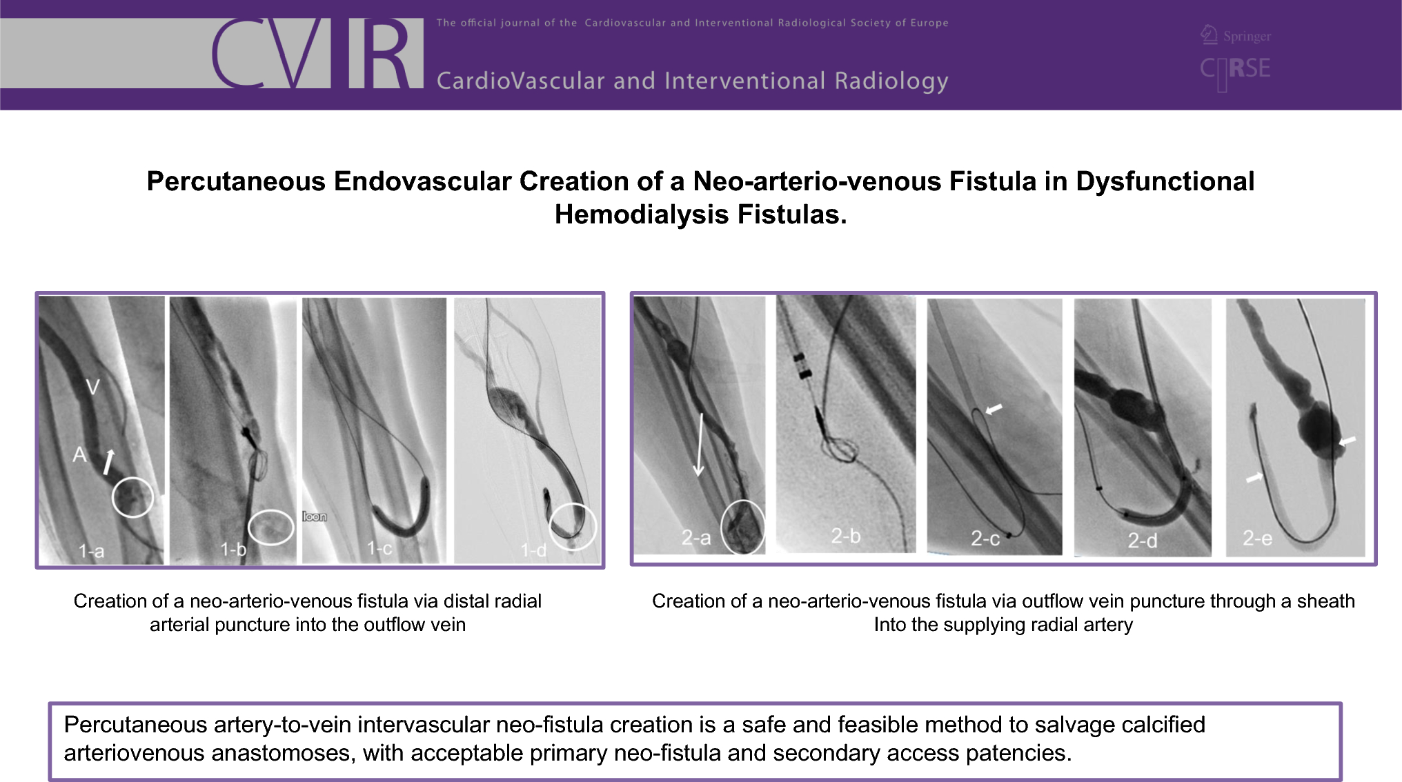 Percutaneous Endovascular Creation of a Neo-arteriovenous Fistula in Dysfunctional Hemodialysis Fistulas