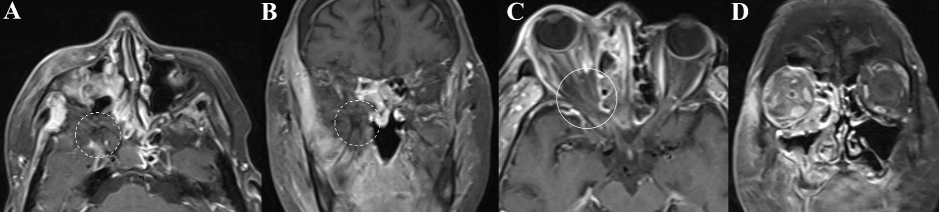 Radiological differentiation between bacterial orbital cellulitis and invasive fungal sino-orbital infections