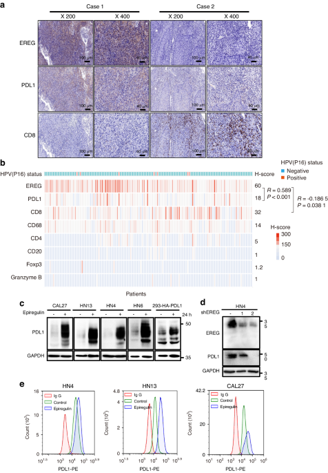 Stabilization of EREG via STT3B-mediated N-glycosylation is critical for PDL1 upregulation and immune evasion in head and neck squamous cell carcinoma