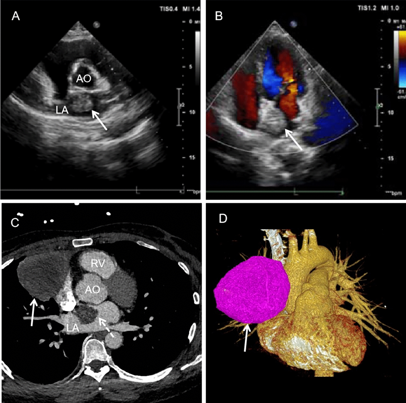 First report of a successful surgical management of left atrial myxoma coexisting with pulmonary squamous cell carcinoma and thymic cyst
