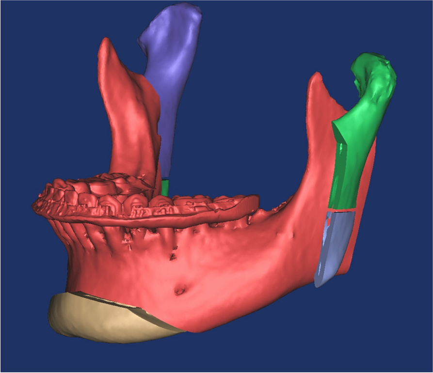 Augmentation genioplasty using discarded bone fragments following proximal segment osteotomy of the ramus in intraoral vertical ramus osteotomy (IVRO)