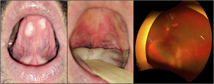Oral and ocular findings in secondary syphilis