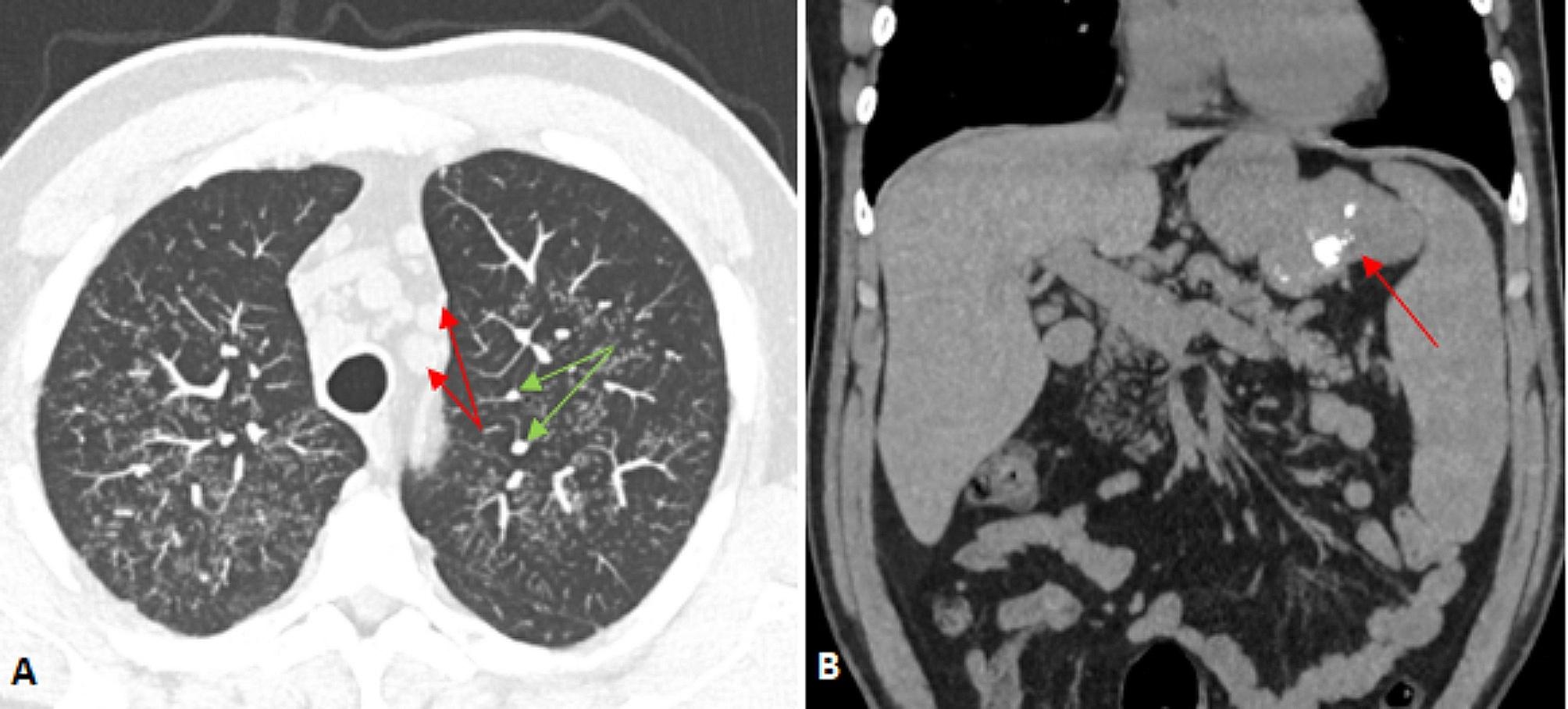 Hypercalcaemia in gastrointestinal stromal tumour and sarcoidosis: a case report