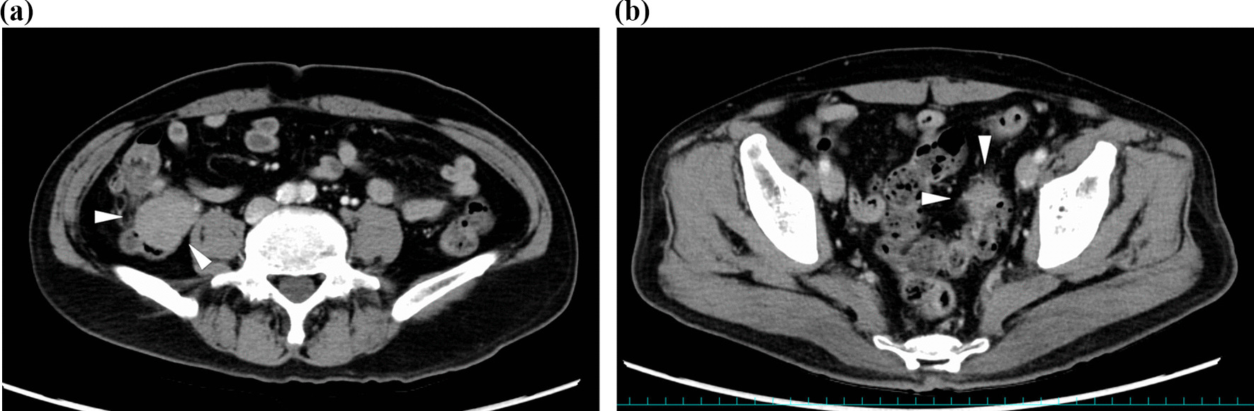 Multiple foci of Rosai–Dorfman disease in colon: a case report