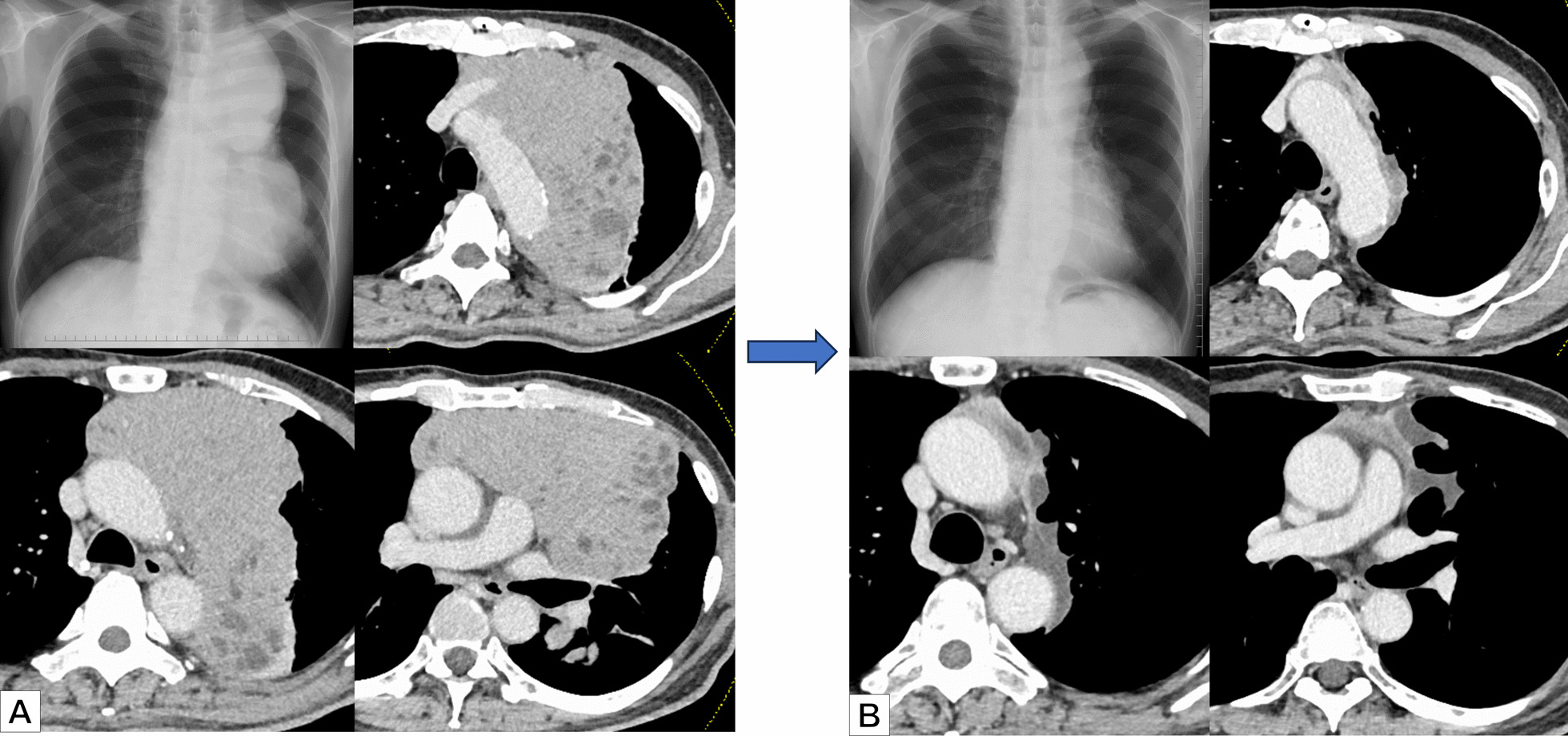 Multidisciplinary treatment of giant thymoma, paving the way to complete surgical resection: a case report