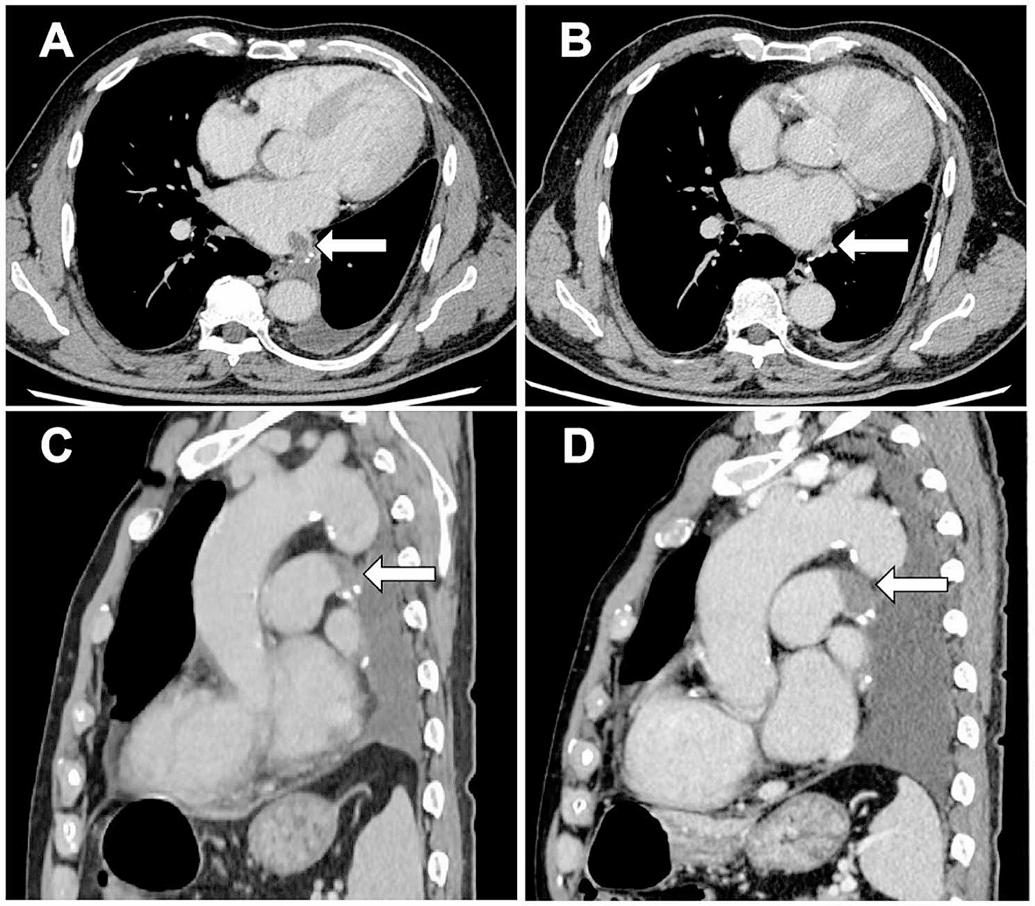 The pulmonary-vascular-stump filling defect on CT post lung tumor resection: a predictor of cancer progression