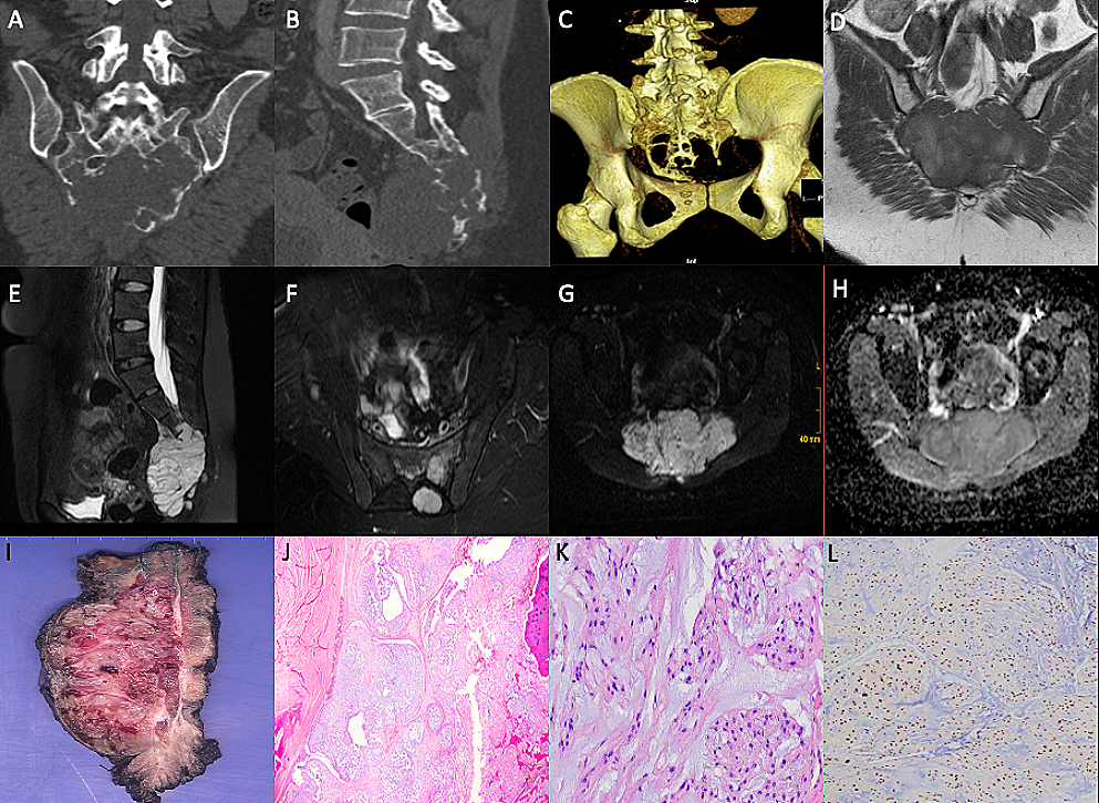 Notochordal cell derived lesions: a 55-year casuistic analysis of 50 cases with radiologic-pathologic correlation in a tertiary referral hospital, and literature review