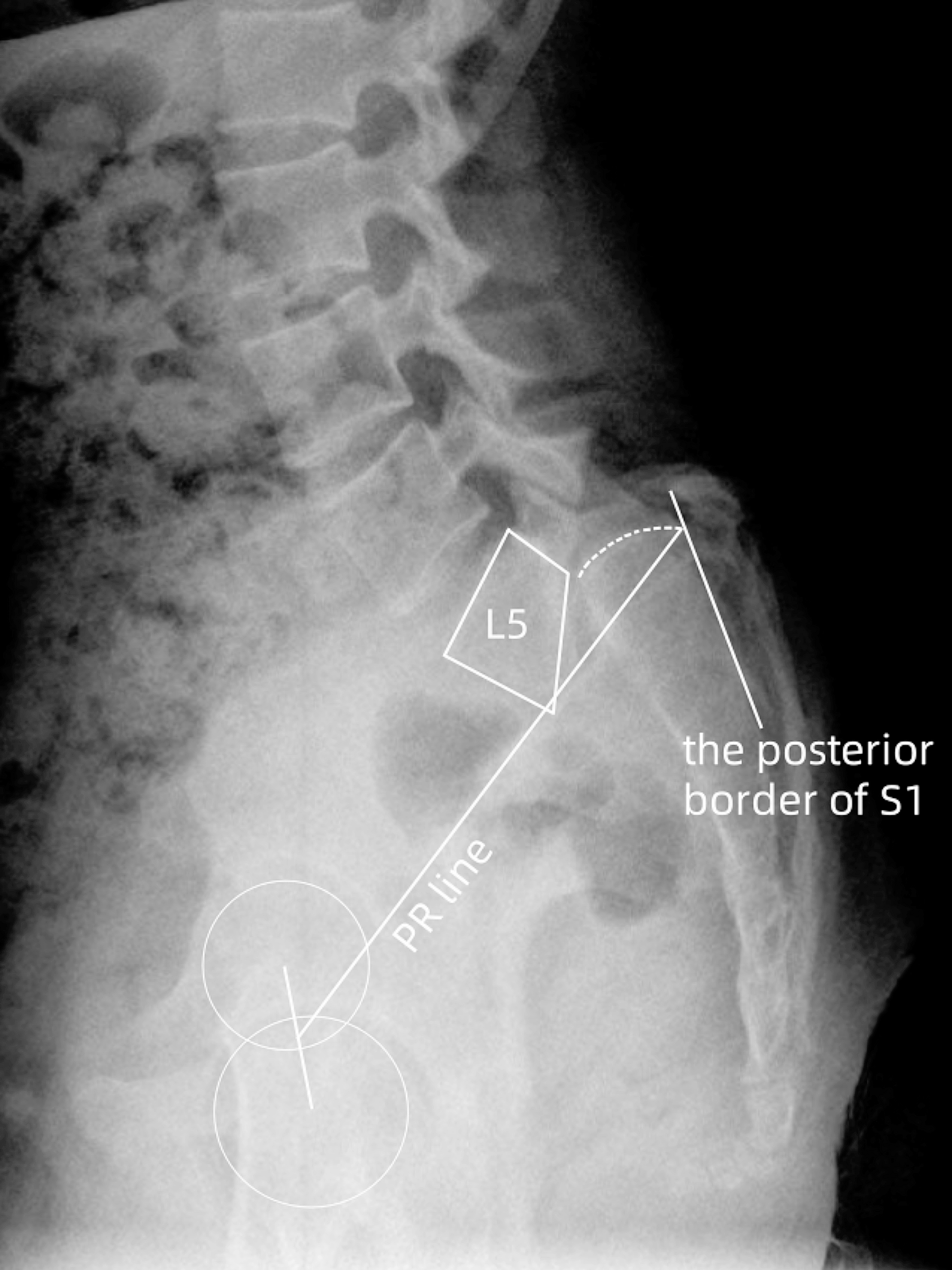 Evaluation of the effectiveness of the femoro-sacral posterior angle system for measuring spino-pelvic morphology in high-dysplastic developmental spondylolisthesis