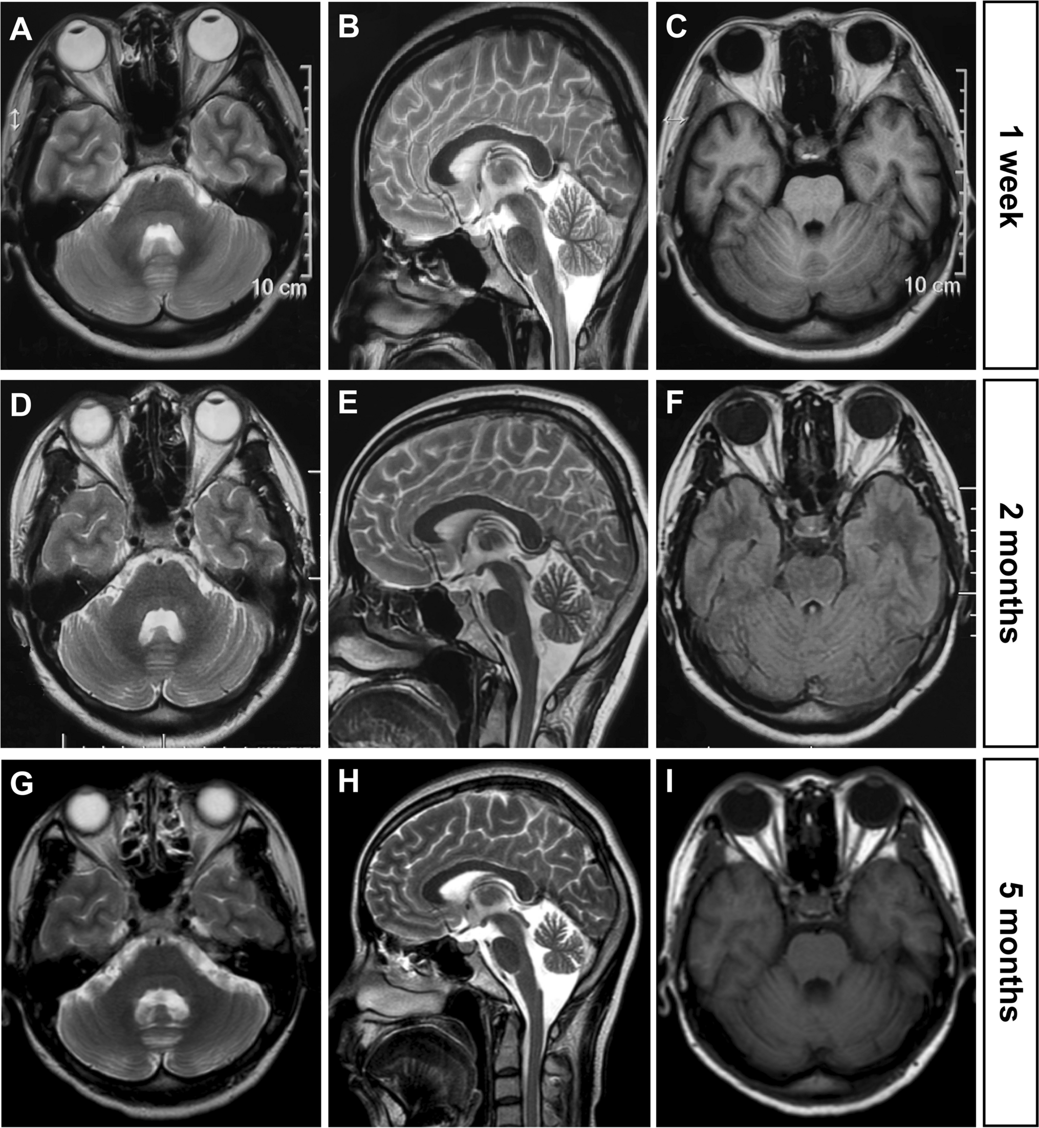 Favorable Outcomes in a Case of Non-paraneoplastic DNER Ataxia Treated with Immunotherapy