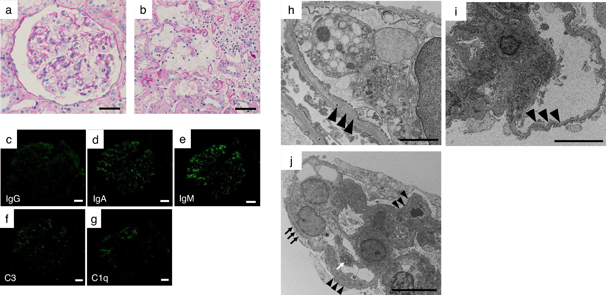 MYH9-related disease with a normal platelet count