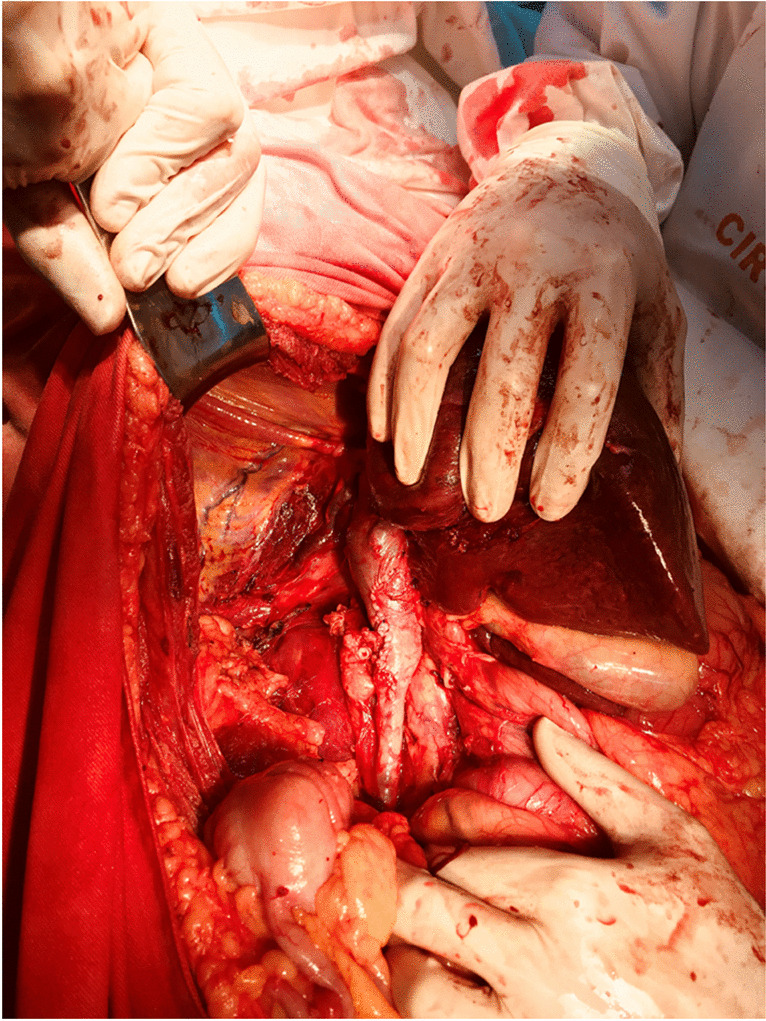 Results of Radical Nephrectomy and Inferior Vena Cava Thrombectomy