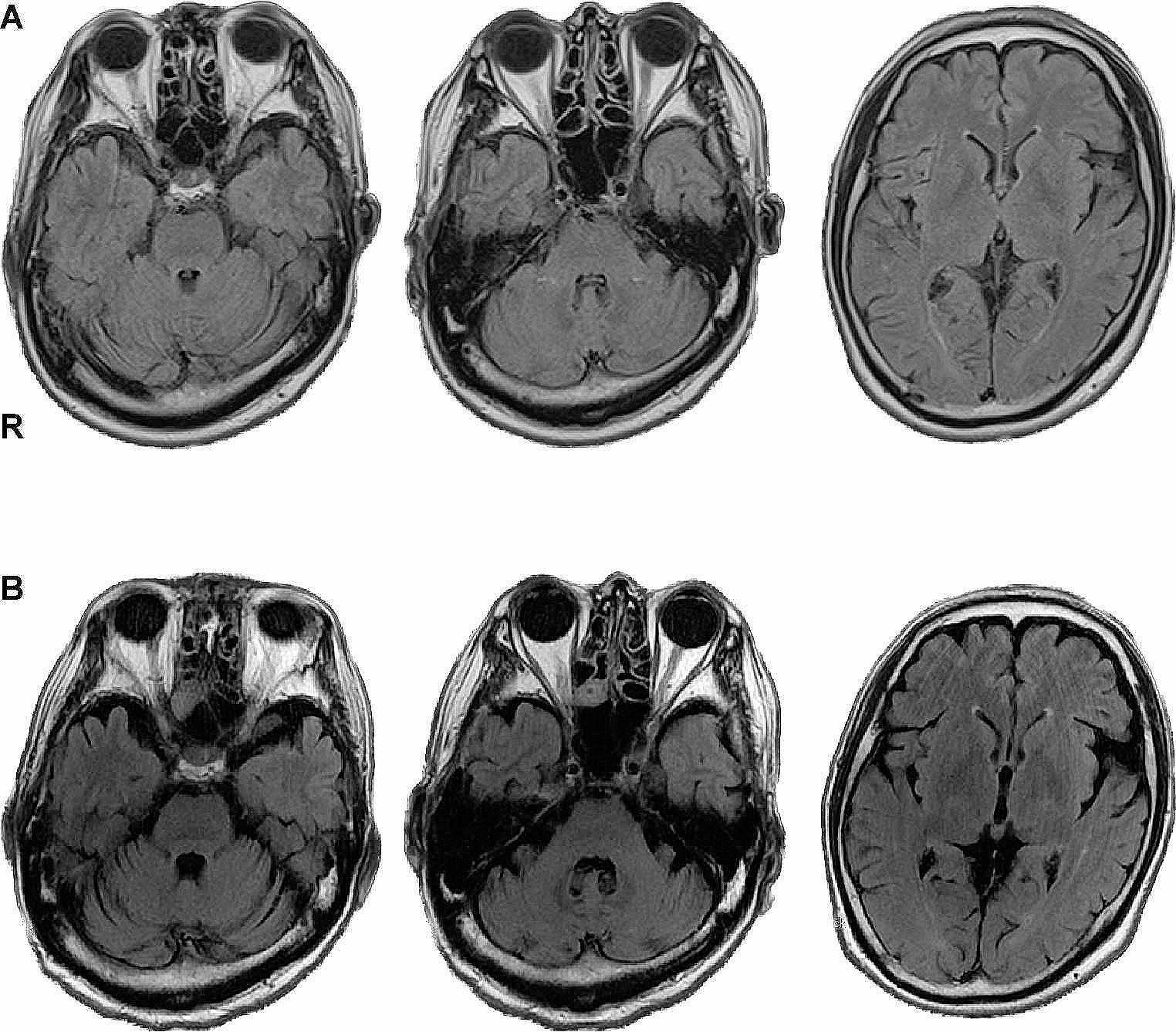 Acute Cerebellar Manifestations without Limbic Involvement in GABAB Receptor Autoimmune Encephalitis: Case Report and Literature Review