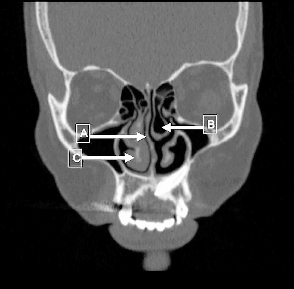 Role of paranasal abnormalities and systemic inflammation on primary acquired nasolacrimal duct obstruction