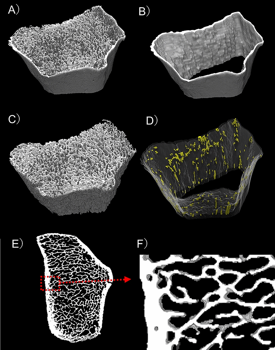 A Randomized Controlled Trial on the Effect of Luseogliflozin on Bone Microarchitecture Evaluated Using HR-pQCT in Elderly Type 2 Diabetes