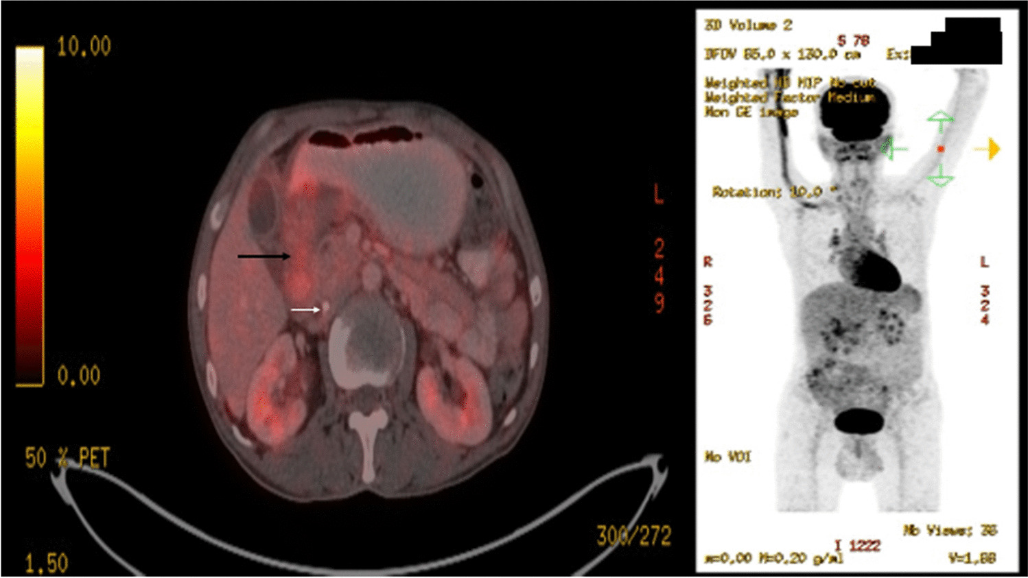 Pancreatic ductal adenocarcinoma with localized lymphangitis carcinomatosis causing gastric outlet obstruction