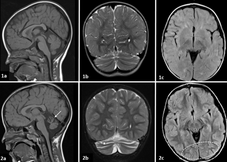 Phenotypic Spectrum and Natural History of Gillespie Syndrome. An Updated Literature Review with 2 New Cases