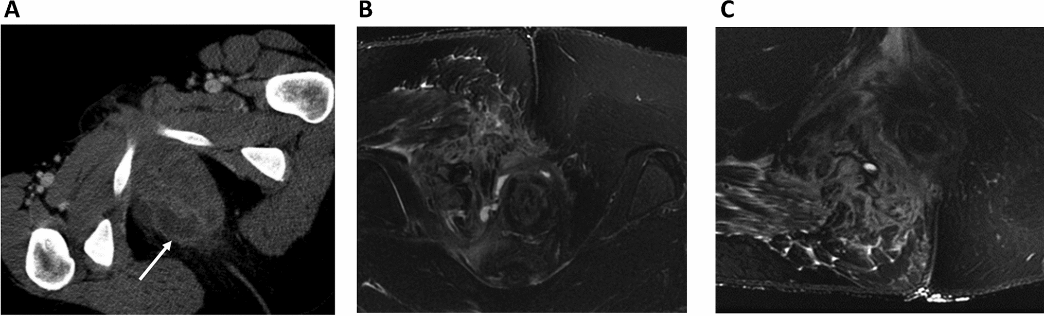 The role of MRI in perianal fistulizing disease: diagnostic imaging and classification systems to monitor disease activity