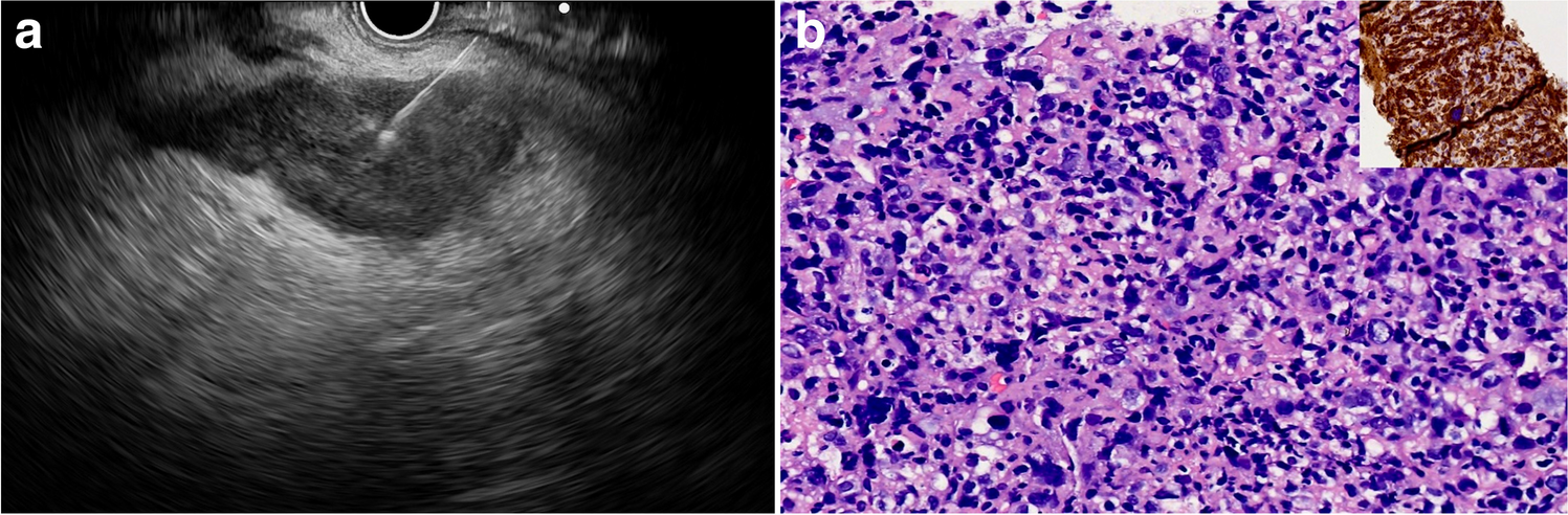 Anaplastic large cell lymphoma of adrenal gland—An endoscopic ultrasound enigma