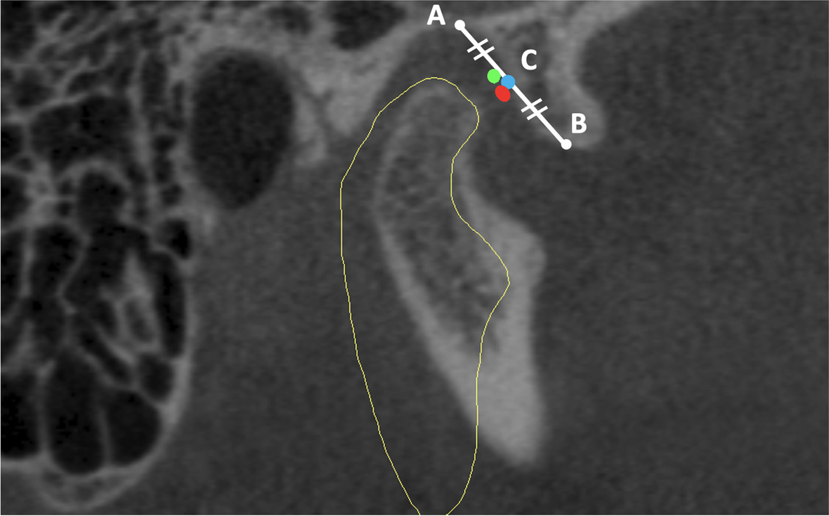 Retrospective analysis of ideal needle puncture angles and depths for temporomandibular joint arthrocentesis using CBCT data