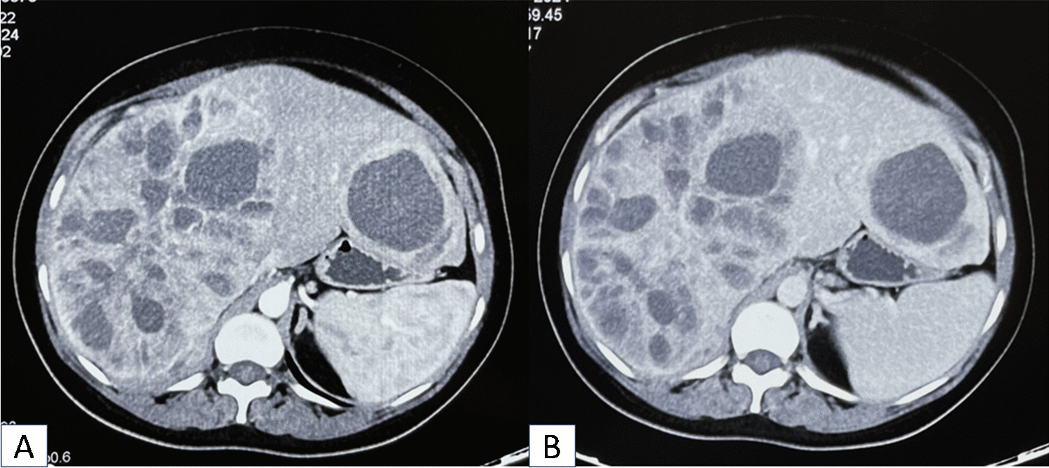 Neuroendocrine tumor masquerading as hepatic hydatid cyst