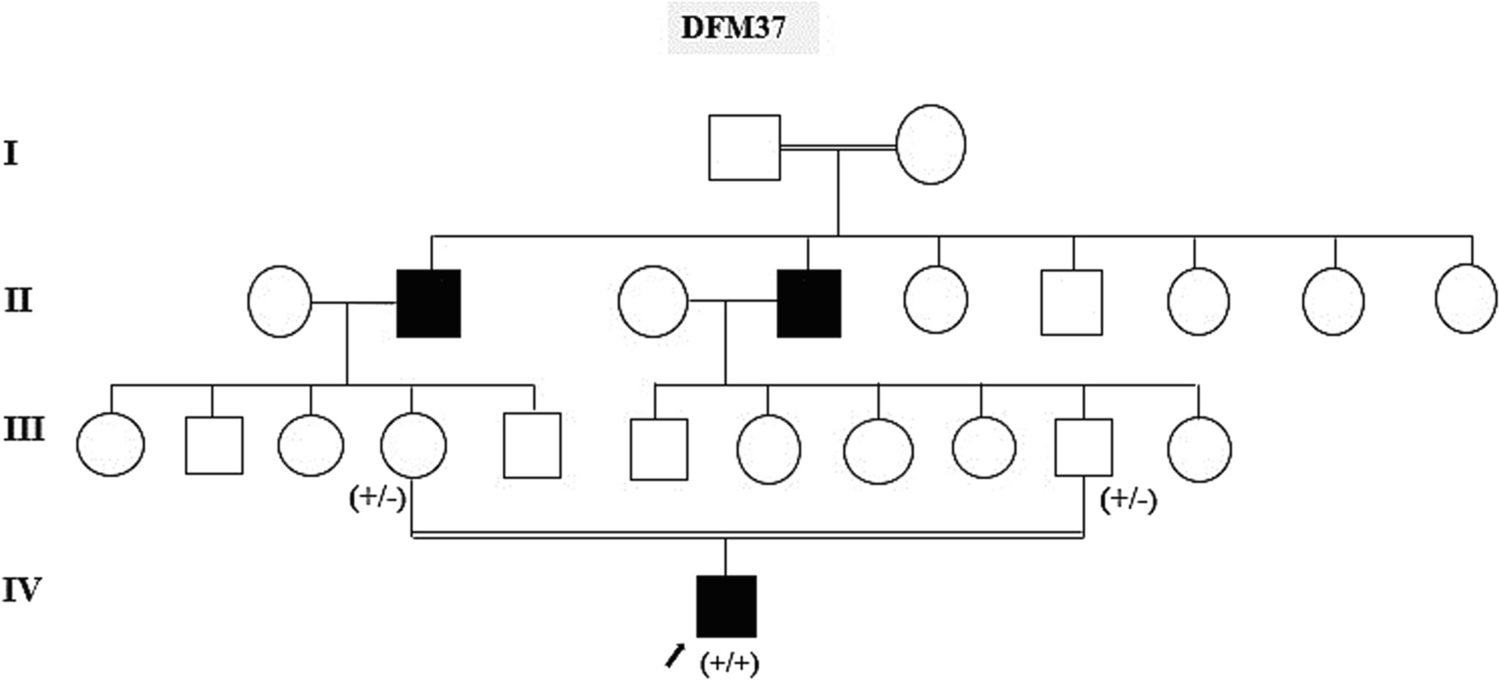 Splice-altering variant of PJVK gene in a Mauritanian family with non-syndromic hearing impairment