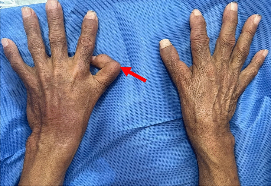 When the heart and hands tell a story: an intriguing case of Holt–Oram syndrome