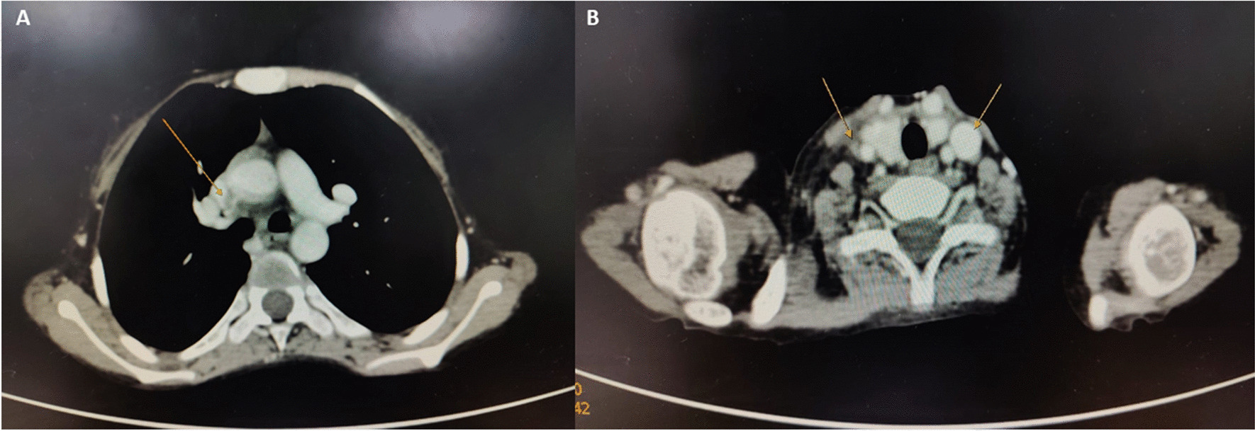 Thromboprophylaxis in pediatric inflammatory bowel disease: Is it time to reframe the guidelines?