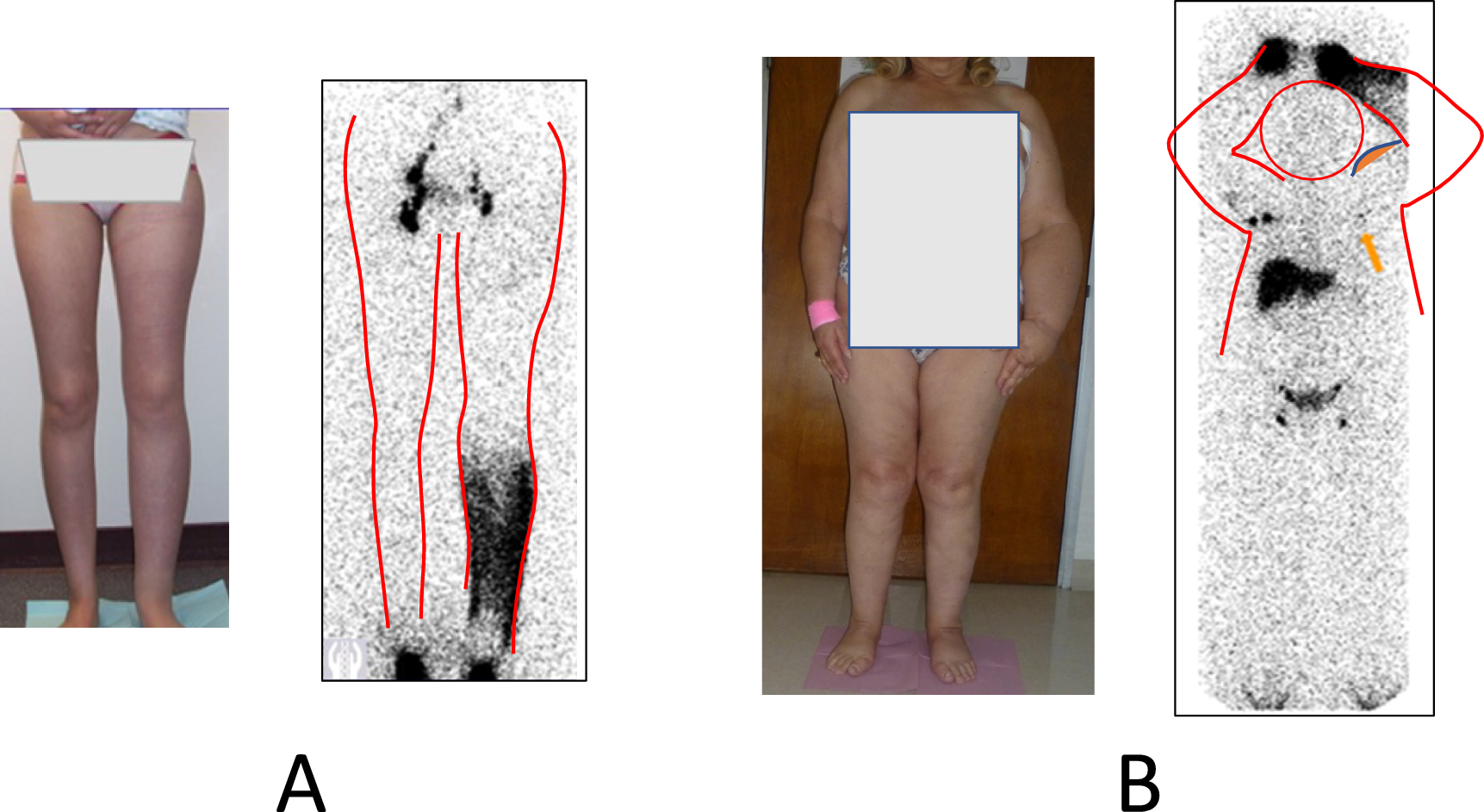 Current diagnostic and quantitative techniques in the field of lymphedema management: a critical review