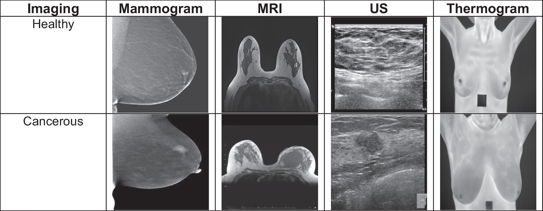 Dual-Tree Complex Wavelet Pooling and Attention-Based Modified U-Net Architecture for Automated Breast Thermogram Segmentation and Classification