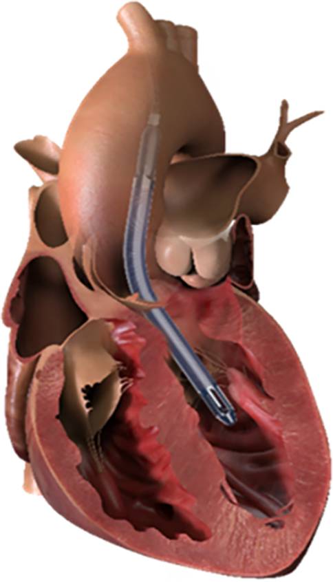 State of the Art Therapie mit Impella® in der Herzchirurgie in Österreich