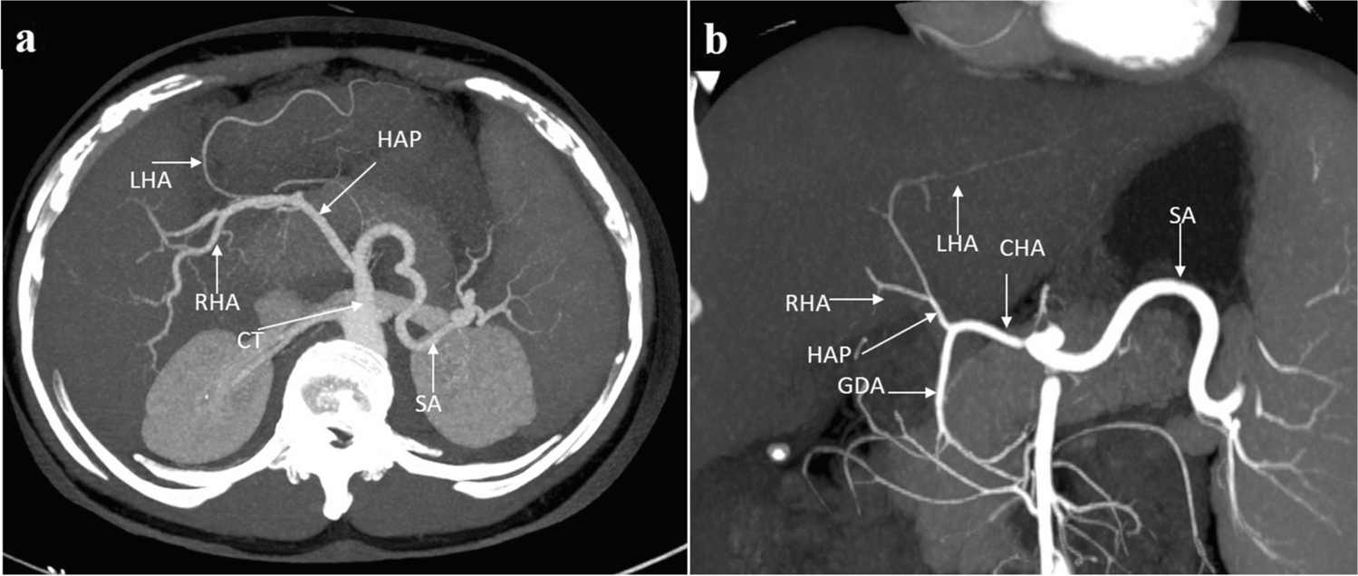 Celiac trunk arterial variations and their clinical implications: Role of imaging