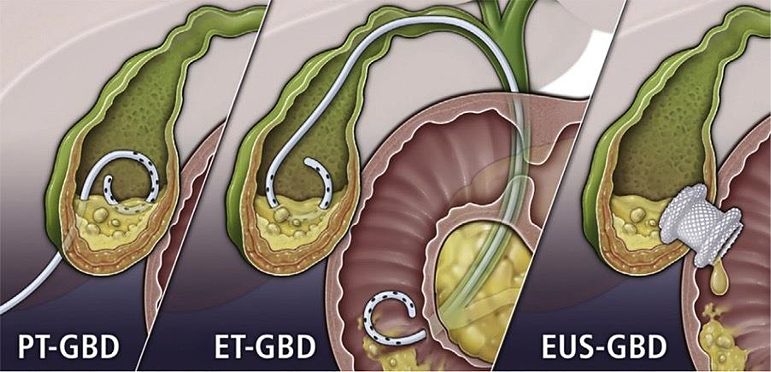 A stent of strength: use of lumen-apposing metal stents (LAMS) for biliary pathologies and other novel applications