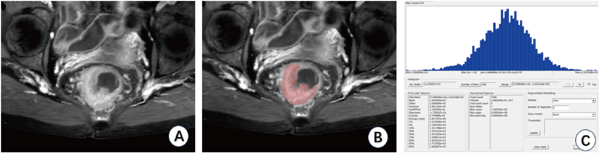 Application of a combined clinical prediction model based on enhanced T1-weighted image(T1WI) full volume histogram in peripheral nerve invasion (PNI) and lymphatic vessel invasion (LVI) in rectal cancer