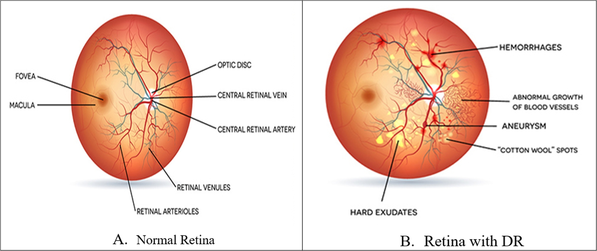 Detection of Diabetic Retinopathy Using Discrete Wavelet-Based Center-Symmetric Local Binary Pattern and Statistical Features