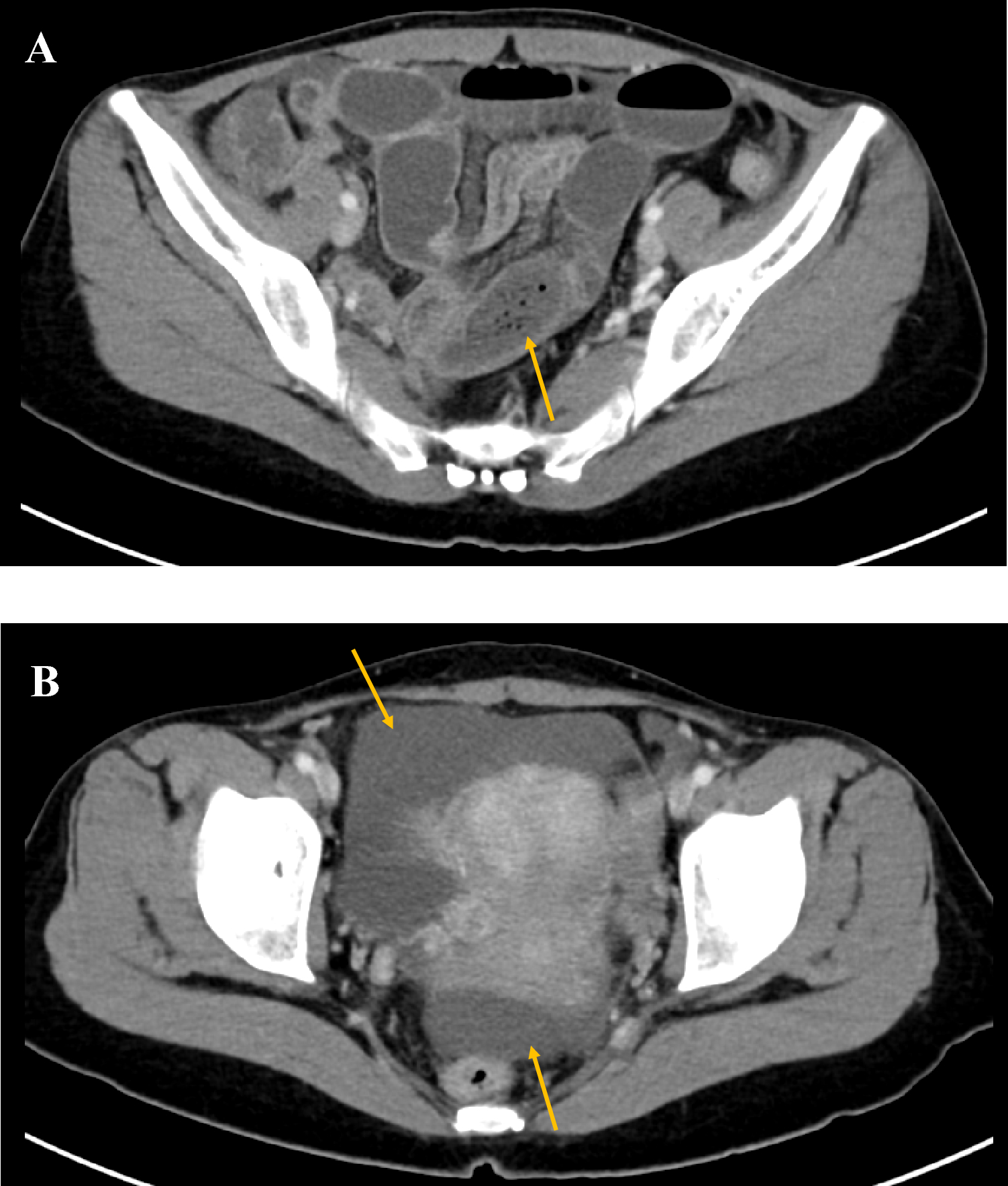 Food-induced small bowel obstruction observed in a patient with inappropriate use of semaglutide