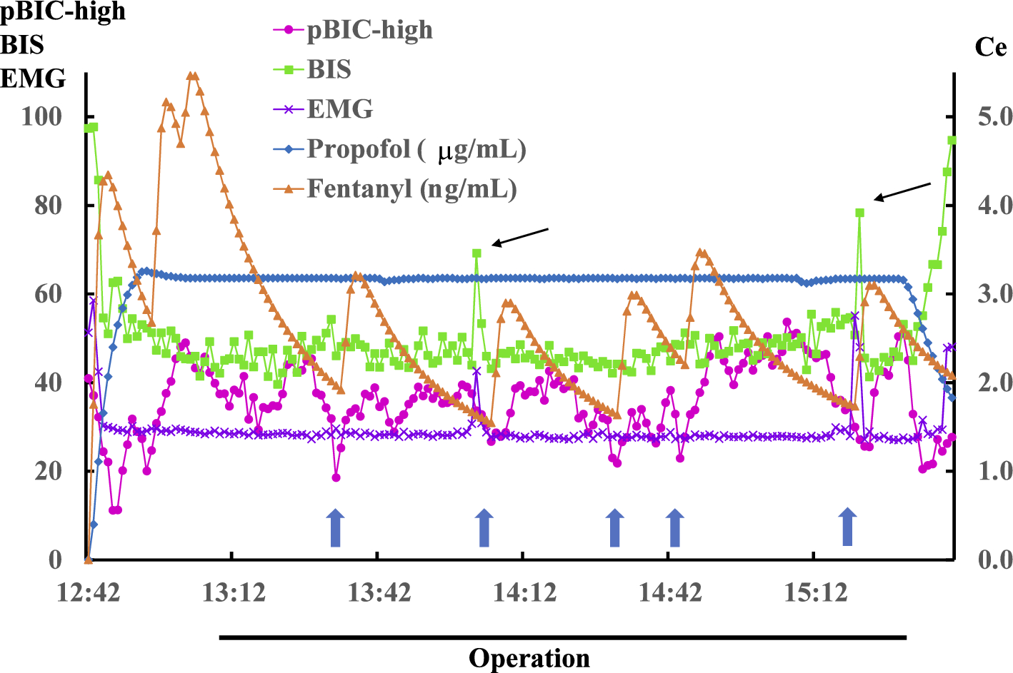 Decrease of the peak heights of EEG bicoherence indicated insufficiency of analgesia during surgery under general anesthesia