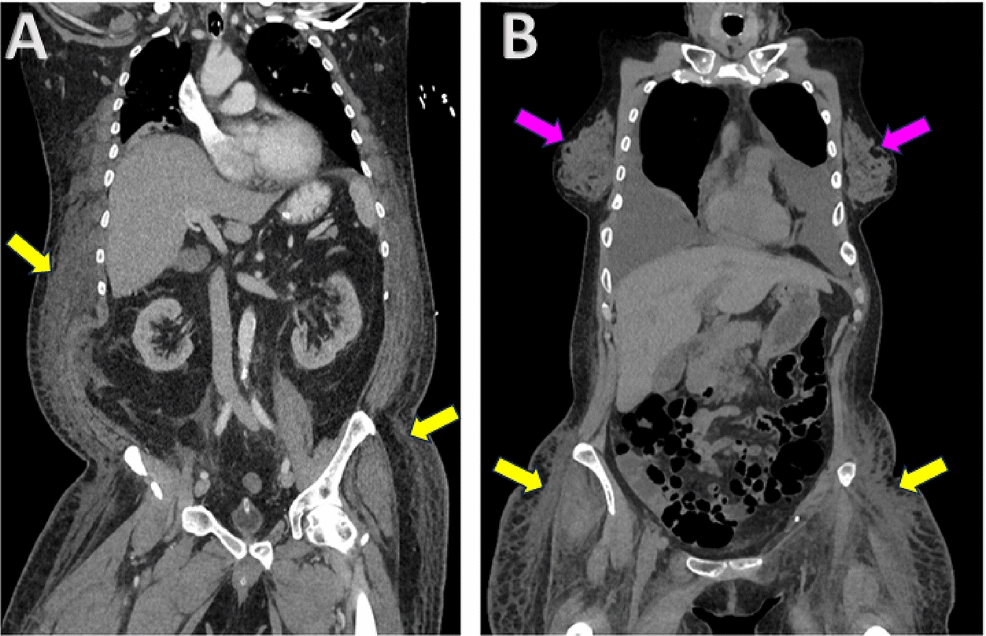 Subcutaneous edema segmentation on abdominal CT using multi-class labels and iterative annotation