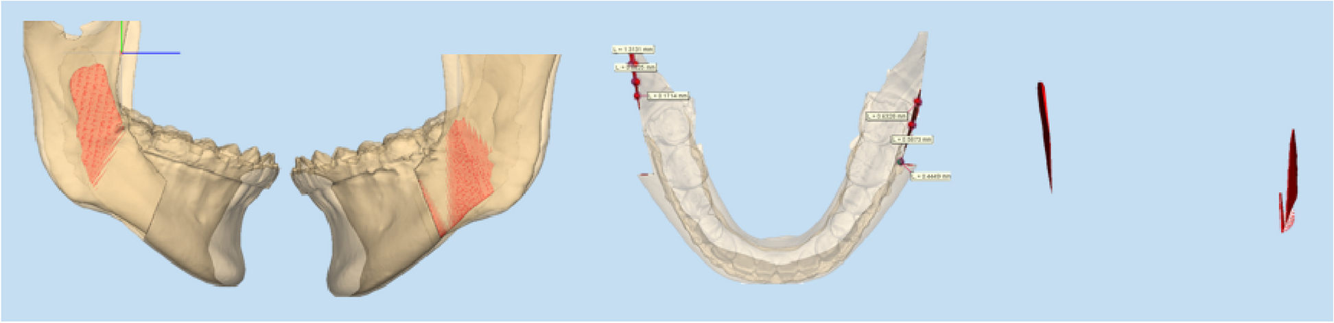 Changes in mandibular width and frontal-lower facial profile after orthognathic surgery using sagittal split ramus osteotomy with removal of internal bone interference in patients with class III skeletal malocclusion