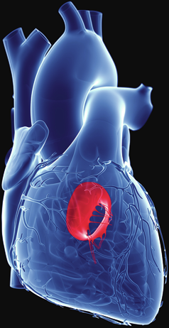 TEER is non-inferior to surgery in patients with secondary mitral regurgitation