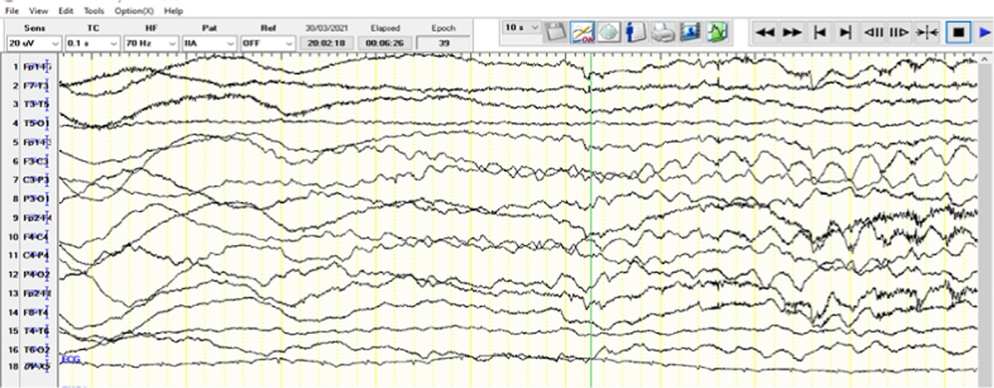 Challenges in the diagnosis of anti-NMDAR disease in a young male patient: a case report