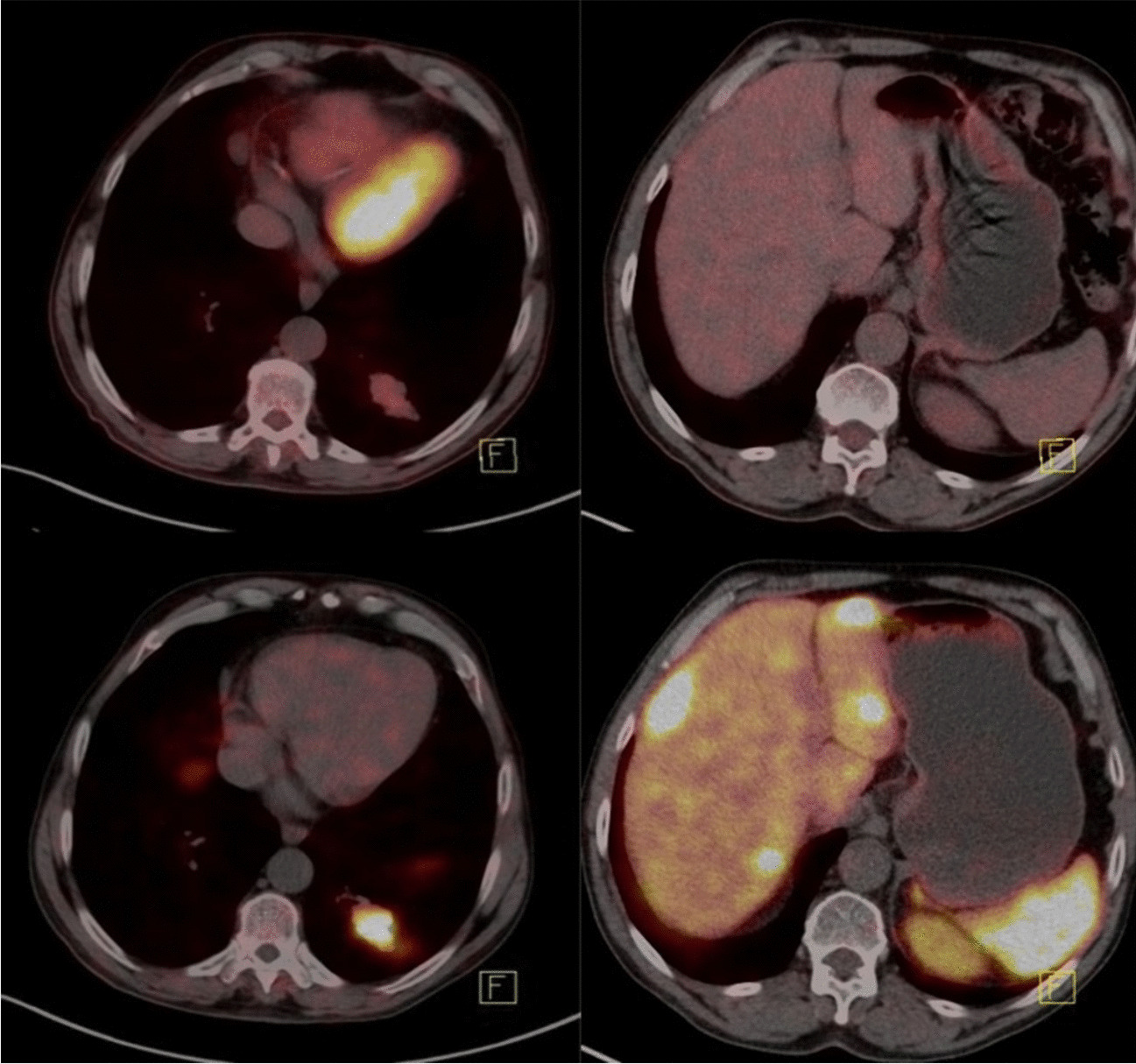 Initial Staging of Lung Cancer with FDG PET/CT